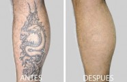 Eliminacion de tatuajes con laser